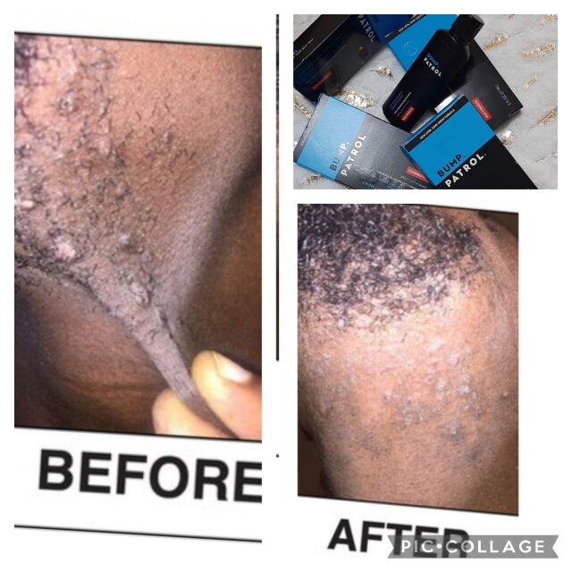 Hair Bumps Removal