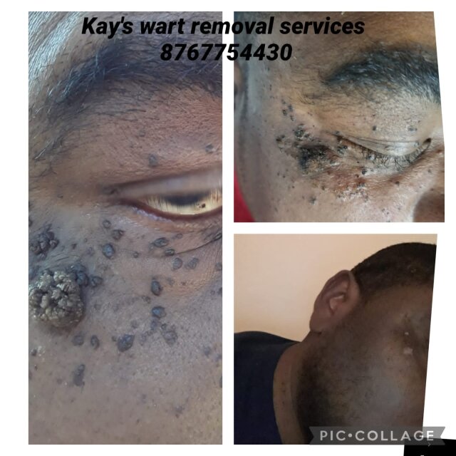 Wart Removal Service's