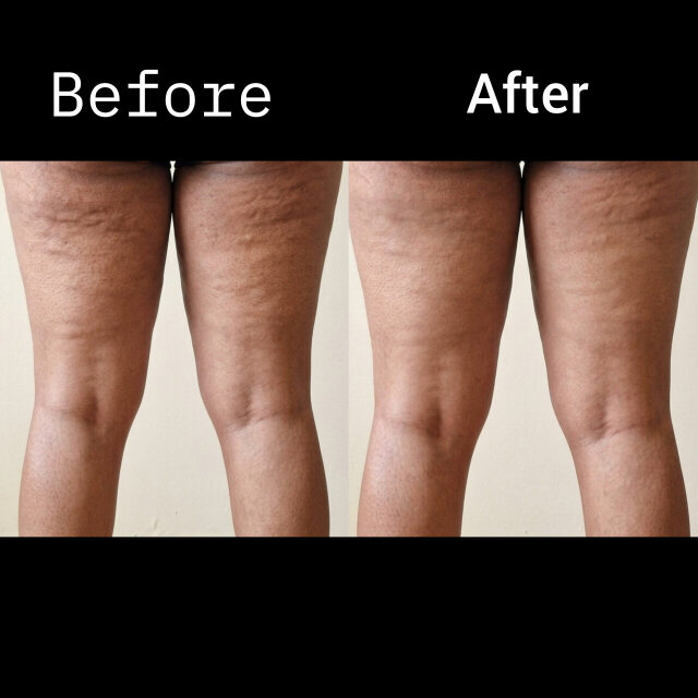 Anti Cellulite Gel
